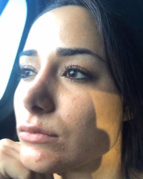 This is me! No filter, no makeup. This skin is caused by food, stress, dry air a...